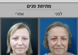 ניתוח מתיחת פנים - תמונות לפני ואחרי