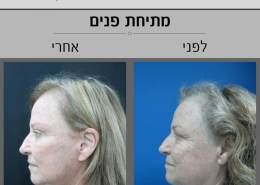 ניתוח מתיחת פנים - תמונות לפני ואחרי