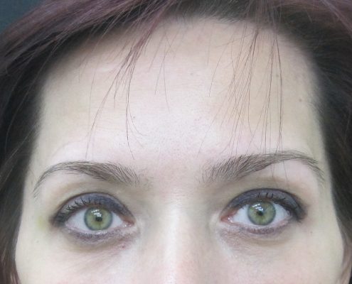 ניתוח הרמת עפעפיים