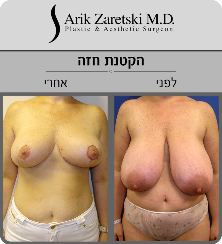 ניתוח הקטנת חזה תמונות לפני ואחרי