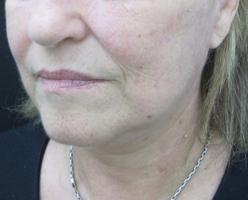 ניתוח הרמת פנים