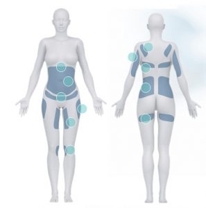 איזורי הקפאת שומן