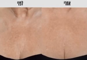 עור המחשוף - לפני ואחרי הזרקה