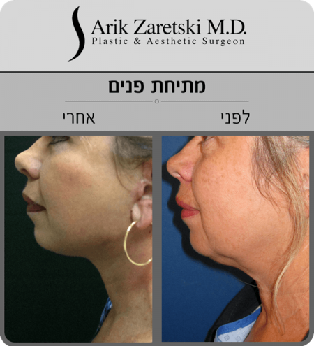 ניתוח הרמת פנים - תמונות לפני ואחרי