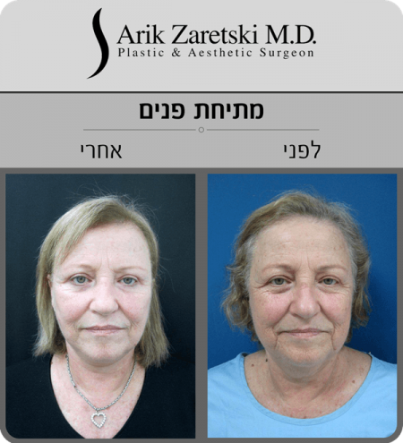 ניתוח מתיחת פנים - תמונות לפני ואחרי