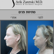 ניתוח מתיחת פנים - תמונות לפני ואחרי | סוגי ניתוח מתיחת פנים