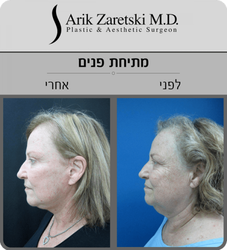 ניתוח מתיחת פנים - תמונות לפני ואחרי | סוגי ניתוח מתיחת פנים