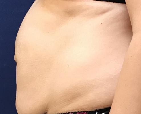 Abdominoplasty pictures before ניתוח מתיחת בטן - פרופיל לפני