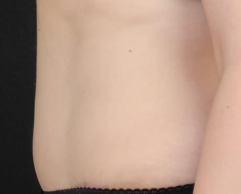 Abdominoplasty tummy tuck after picture ניתוח מתיחת בטן אחרי