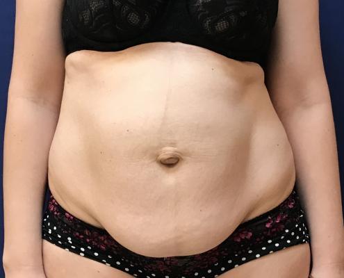 tummy tuck surgery ניתוח מתיחת בטן - לפני