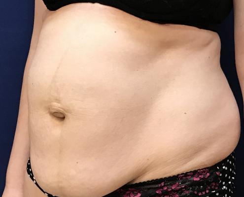 tummy tuck surgery before and after ניתוח מתיחת בטן - תמונה לפני הניתוח