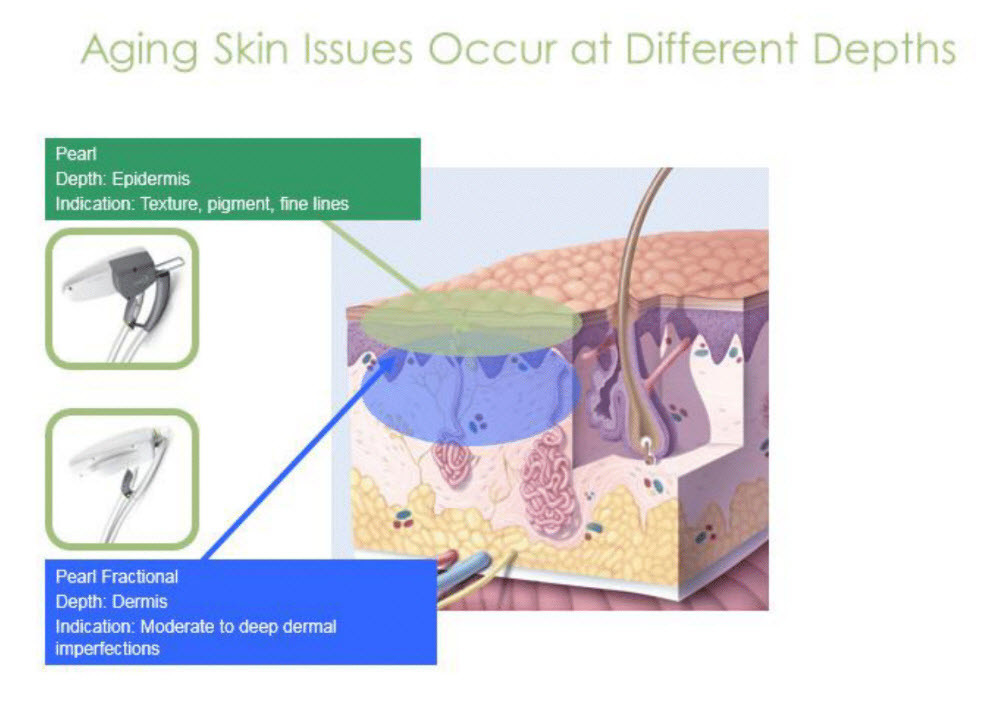 שכבות העור בטיפולי לייזר